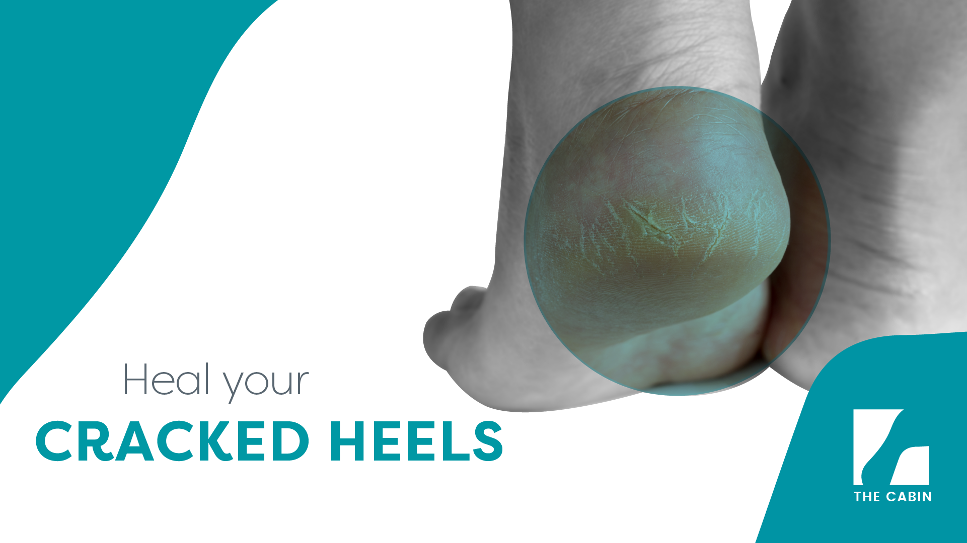 This Is How to Heal Dry, Cracked Feet for Good | HUM Nutrition Blog